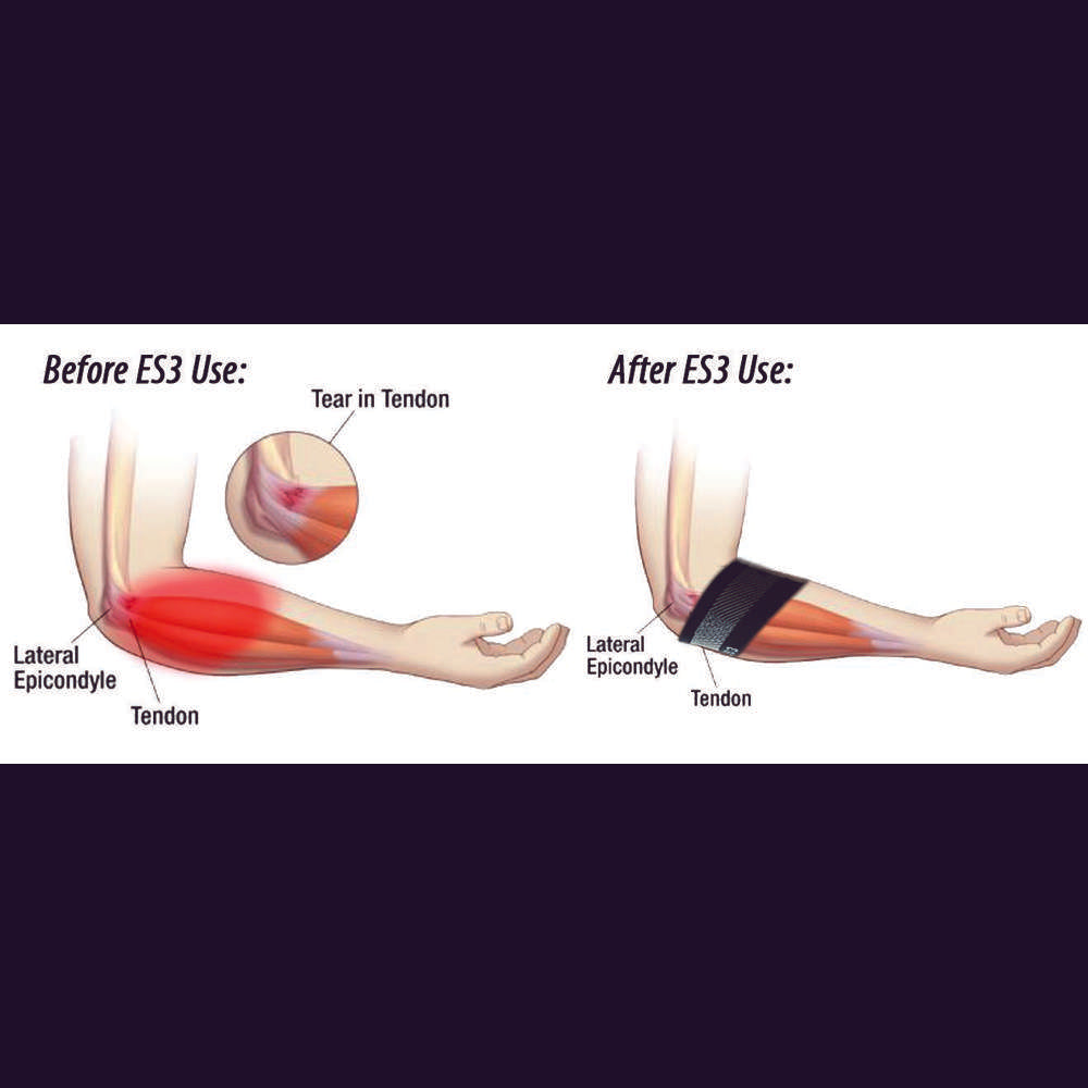 Elbow Compression Sleeve For Bursitis (ES3) - Black